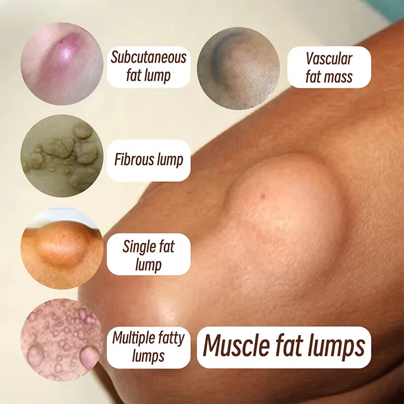 Skin Care Soothing Knot Care Cream Subcutaneous Lumps Remover Relieves Body Agglomeration Hard Blocks Body Skin Care Cream - Timeless Beauty