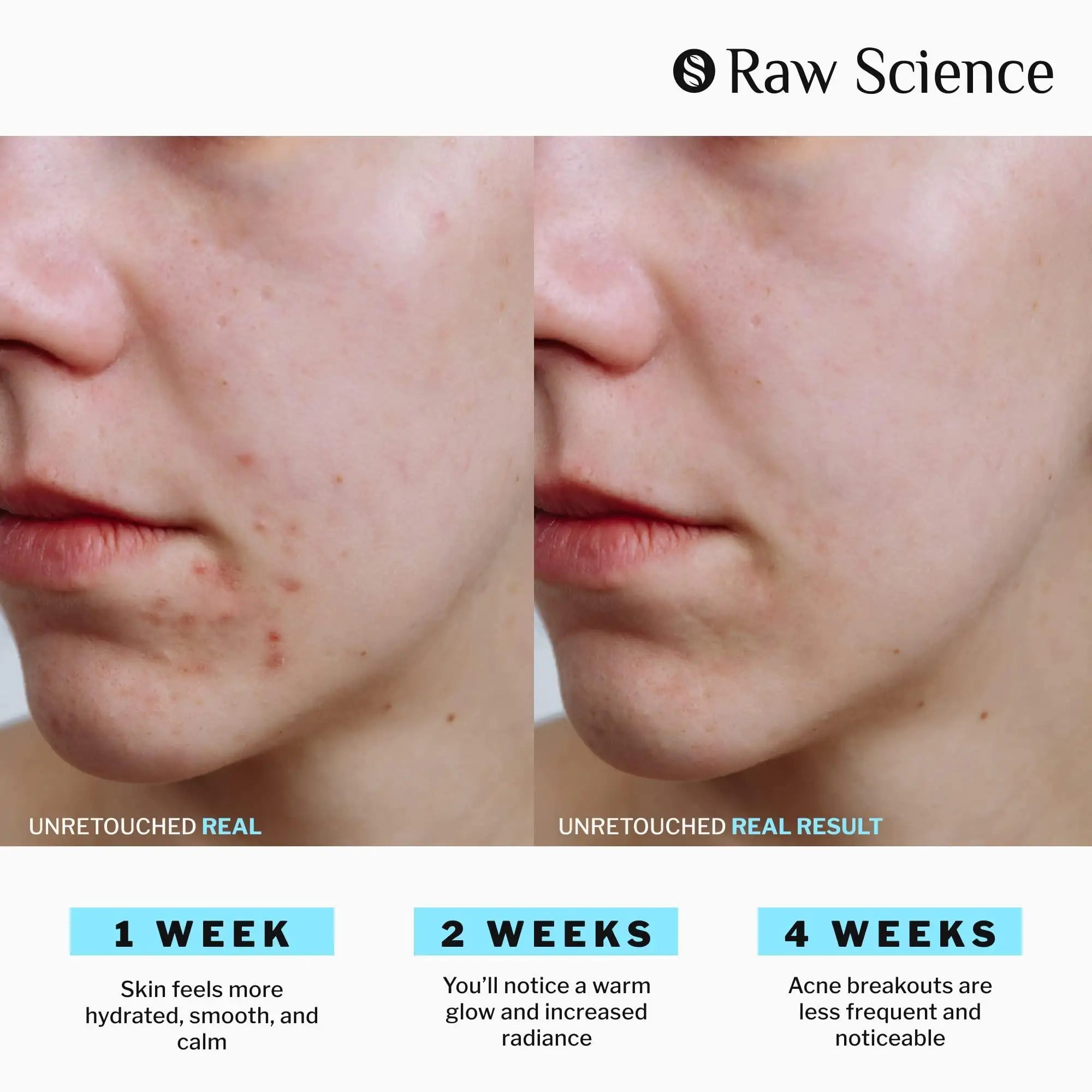 Anti Acne Supplements Cystic Acne Treatment for Teens Breakout Control 60 Caps - Timeless Beauty