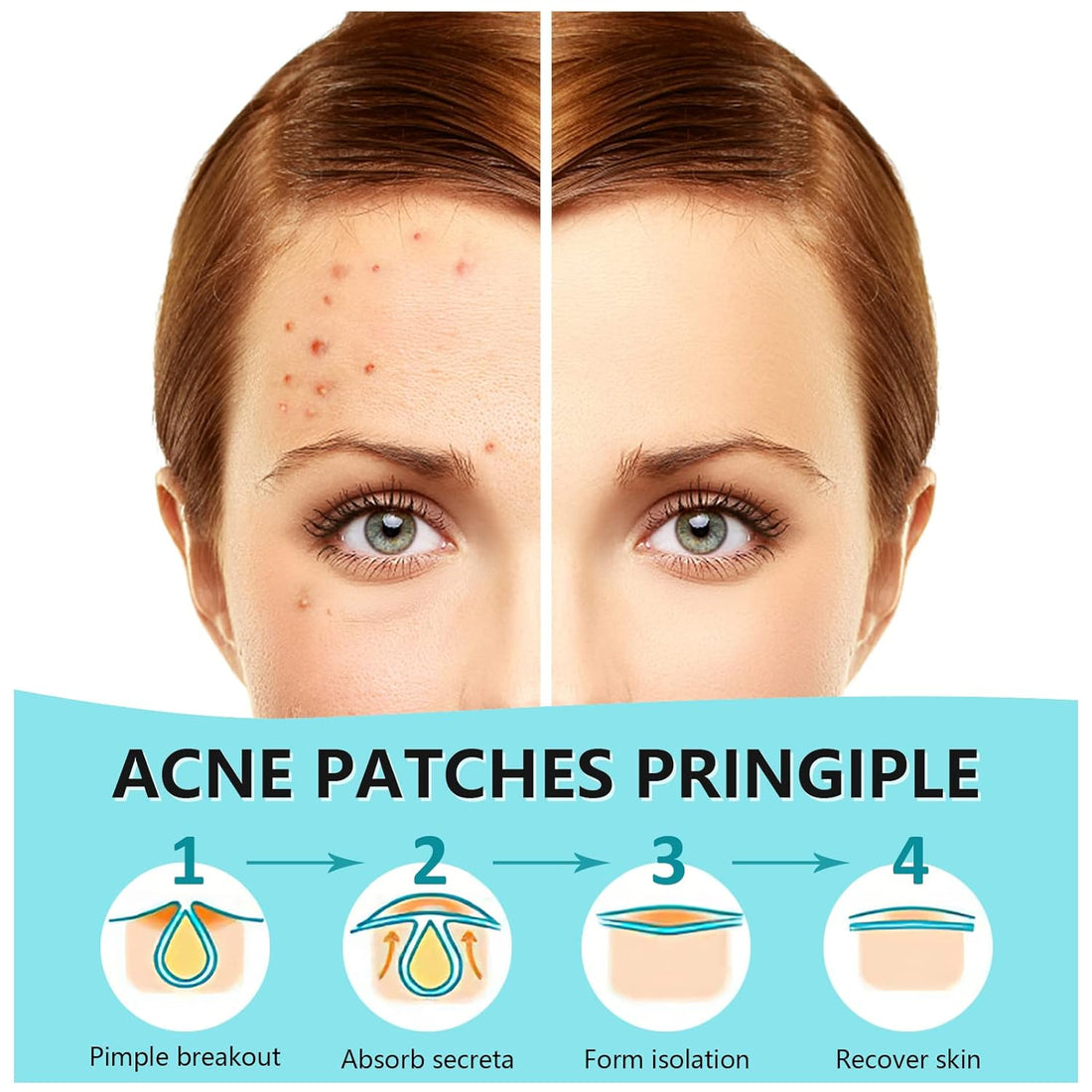 180 Counts Pimple Patches for Face Hydrocolloid Acne Patches for Face Invisible Zit Patches for Face Pimple Patch Acne Spot Treatment Patch Blemish Patches Cover Patches Stickers - Timeless Beauty